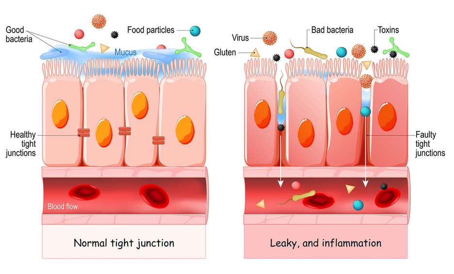 Diagram comparing a normal tight junction in the gut lining to a leaky, inflamed junction